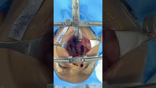 Cleft palate repair  how it looks immediately on completion [upl. by Dazhahs]