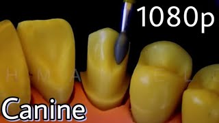 All Ceramic Crown Preparation for Maxillary Canine [upl. by Anela]