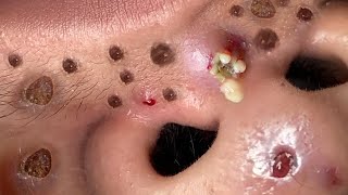 Blackhead Removal With Sac Dep Spa 100074089 [upl. by Yrailih]