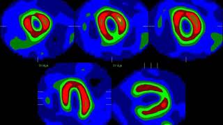 Myocardial Perfusion Imaging Segments [upl. by Barny]