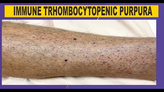 ITP  Immune Thrombocytopenic Purpura [upl. by Ellerahc]