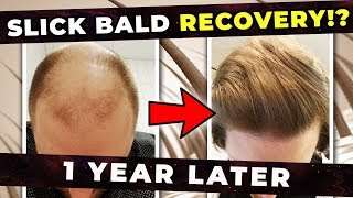 Do Hair Follicles Permanently Die After You Go Bald Can They Be Recovered [upl. by Aekal]