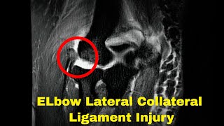 Elbow Lateral Collateral Ligament Injury [upl. by Einnahpets]