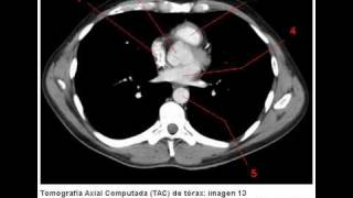 Tomografía Axial Computada TAC de tórax ventana mediastinal [upl. by Zerdna30]