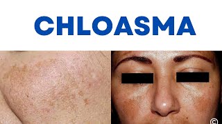 What is Chloasma Chloasma vs Melasma Mask of Pregnancy What causes Chloasma Chloasma Treatment [upl. by Treboh]