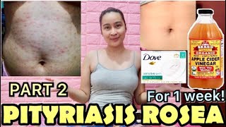 PITYRIASIS ROSEA WHAT’S MY STORY PHILIPPINES [upl. by Ilatan]