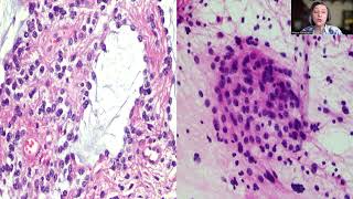 Tip31Pilocyticastrocytoma of an Adult [upl. by Senilec]