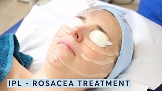 How to treat rosacea  IPL [upl. by Barrus]