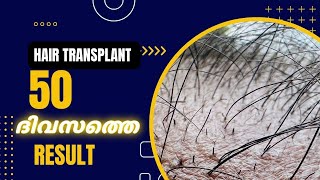 Hair transplant after 50 days  താരൻ വരാൻ തുടങ്ങി  safvan pullara [upl. by Osber]