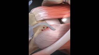 Subscapularis tendon tear  animationshorts shortsfeed youtubeshorts viralshorts [upl. by Marthe247]