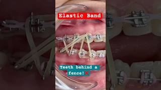 Elastic Band Orthodontic Braces [upl. by Naarah]