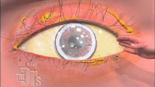 Cholesterol Deposits in the Eye The Doctors [upl. by Mcquillin]