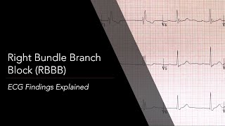 Right Bundle Branch Block RBBB ECG [upl. by Etnaihc]