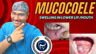 Dr Rudra Mohan  Sweling in Lower Lip or Lower Undersurface of Tongue  Oral Mucocoele [upl. by Tnairb626]