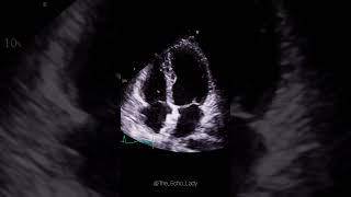 Closure device in situ 🩵🫀 cardiology amplatzer cardiologia echocardiogram [upl. by Melia]