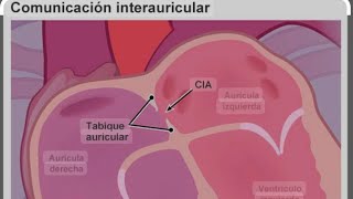 Prueba de la burbuja y Comunicación Inter auricular [upl. by Alvy]