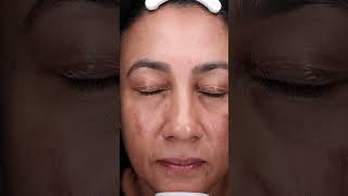 A demonstration of the mesoestetic® mesopeel® melanostop tran3x with Luxe Skin Aesthetics UnboxMe [upl. by Acimad]