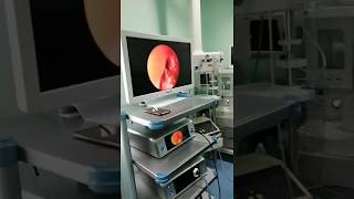 NASAL POLYP  ENDOSCOPIC SURGERY OF Nasal Polyp [upl. by Dinah]