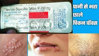 Acivir 200 DT Tablet  Aciclovir 200mg Tablet  Acivir 200mg DT Tablet मुंह के ऊपर छाले बदन पे छाले [upl. by Adnuahsal]