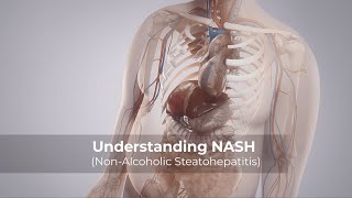 Understanding NASH NonAlcoholic Steatohepatitis [upl. by Enelrihs664]