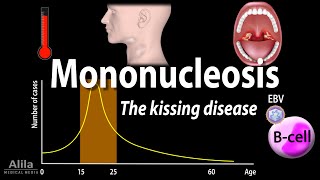 Infectious Mononucleosis Mono  the Kissing Disease Animation [upl. by Paget88]