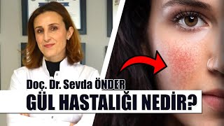 Gül Hastalığı Rozasea Nedir Gül Hastalığının Tedavisi Nasıl Yapılır  Doç Dr Sevda ÖNDER [upl. by Lebasile]