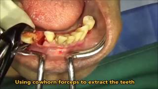 Extraction of severe periodontitis abscess teeth in lower jaw [upl. by Reich]