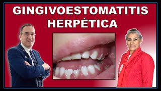 GINGIVOESTOMATITIS HERPÉTICA AGUDA  Virus Herpes Simple VHS1 [upl. by Knute]