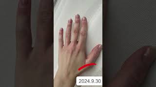 Vitiligo on Hands  Best treatment for vitiligo  Vitiligo Specialist [upl. by Nemhauser]