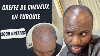 Résultat de la greffe de cheveux  Greffe de cheveux avant et après 1 mois [upl. by Grenier]