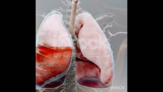 Thoracentesis How to Do It Safely [upl. by Mayhs]