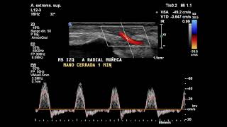 Ecografía Doppler de miembro superior izquierdo [upl. by Onilatac]