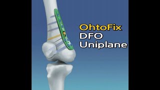 Ohtofix  DFOUniplane sawbone실험 [upl. by Beverie716]