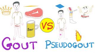 Gout vs Pseudogout  MSU vs CPPD disease  Rheumatology Series [upl. by Otipaga889]