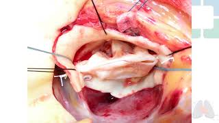 Aortic Valve Repair Graphic [upl. by Mohun]