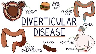 Understanding Diverticulosis and Diverticulitis [upl. by Aihtak]