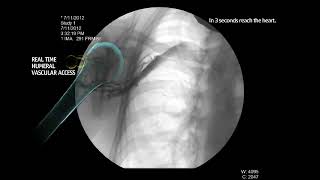 EZ IO Infusion Fluoroscopy Proximal Humerus [upl. by Macdermot]