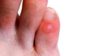 How to Prevent amp Treat Foot Blisters  Foot Care [upl. by Nolava190]