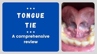 Tonguetie a comprehensive Review  Ankyloglossia [upl. by Shewchuk]