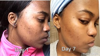 How to remove pimples amp dark spots in a week  South African Youtuber [upl. by Aliban]