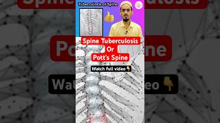 How Tuberculosis Targets Your Spine A Quick Guide pottspine spinetb shorts [upl. by O'Donnell605]