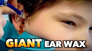 GIANT EAR WAX REMOVAL  Dr Paul [upl. by Ody830]