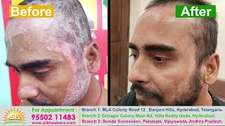 Best Psoriasis treatment in Hyderabad Sri Bhaskara Kerala Ayurveda hospital call 7981855536 [upl. by Ennaihs]