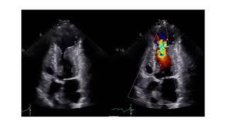 How to Assess the Level of Obstruction with Echocardiography in Patients with HCM [upl. by Nilahs]