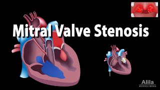 Mitral Valve Stenosis Animation [upl. by Halac]