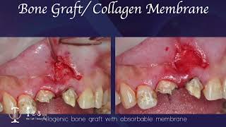 Restorative Crown Lengthening in Esthetic Zone amp Apicoectomy with Giuded Tissue Regeneration V [upl. by Ajram]