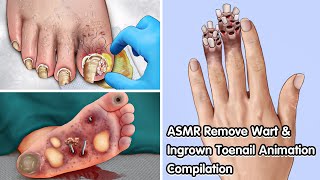 ASMR Remove Wart amp Ingrown Toenail Animation Compilation  Deep Cleaning Animation [upl. by Nash]