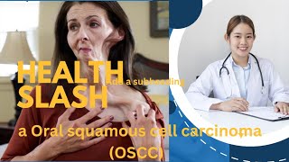 what is Oral squamous cell carcinoma OSCC  Health How to treat it [upl. by Eellac409]