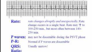 ECG Paroxysmal Supraventricular Tachycardia PSVT [upl. by Eiramanna754]