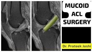 Mucoid Degeneration of ACL ligament  Arthroscopic Debulking of ACL ligament  Dr Prateek Joshi [upl. by Nitsur894]